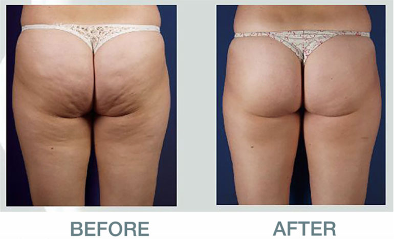 Cavitation before and after treatment