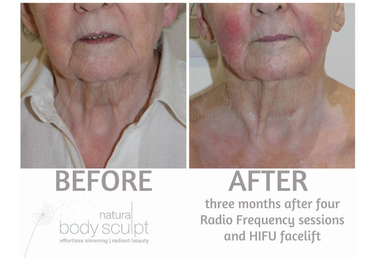 HiFu Facelift Before and after treatment
