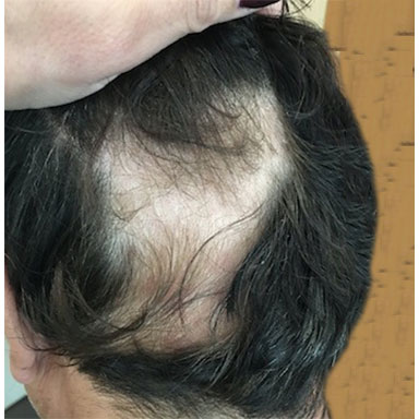 Hair Loss - Before treatment
