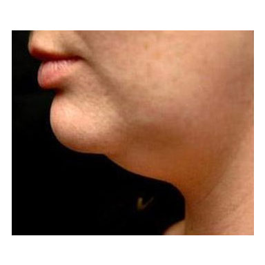 Chin before laser lipo treatment