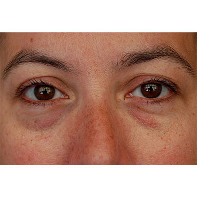 eye bags before laser lipo treatment