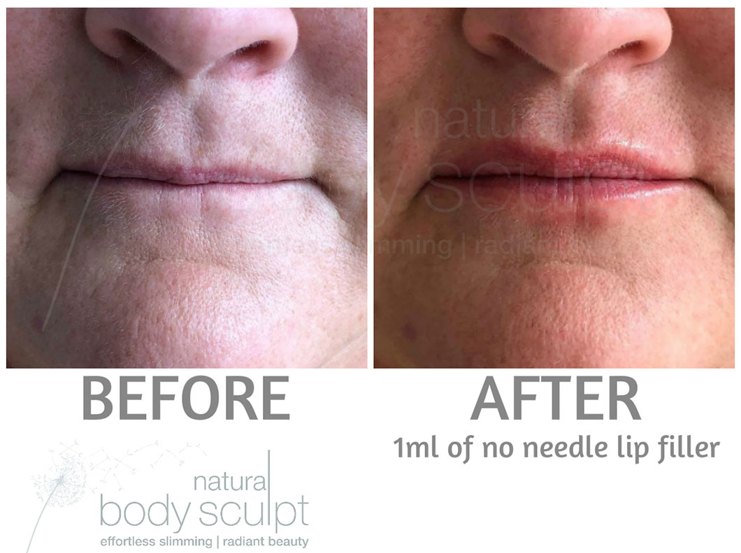 No Needle filler Results