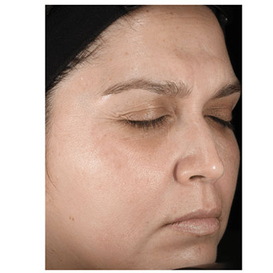 Age Spots