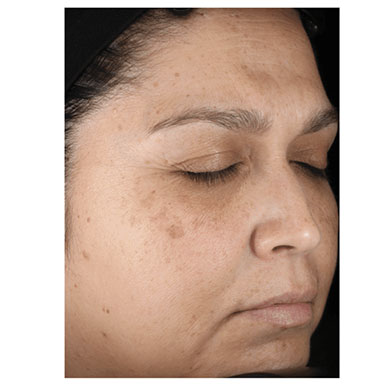 Age Spots