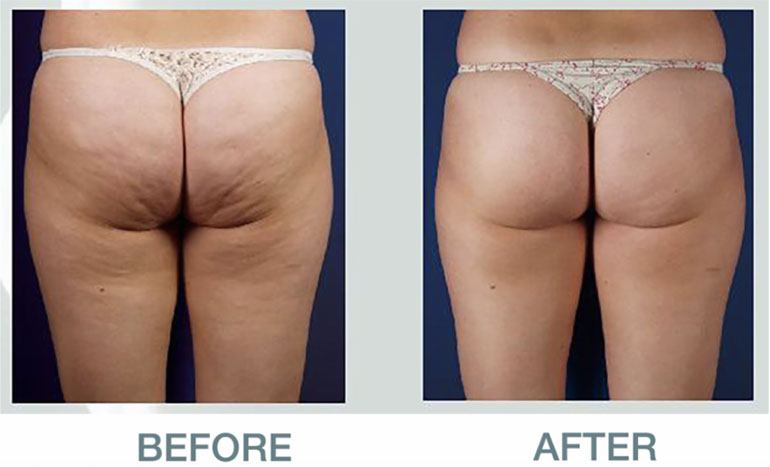 Summer Body Time - Bodysculpt