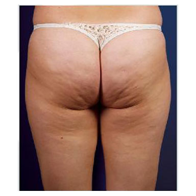 natural body sculpt - cavitation inch loss and cellulite reduction