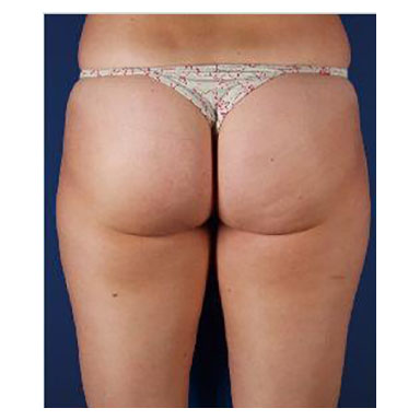 natural body sculpt - cavitation inch loss and cellulite reduction