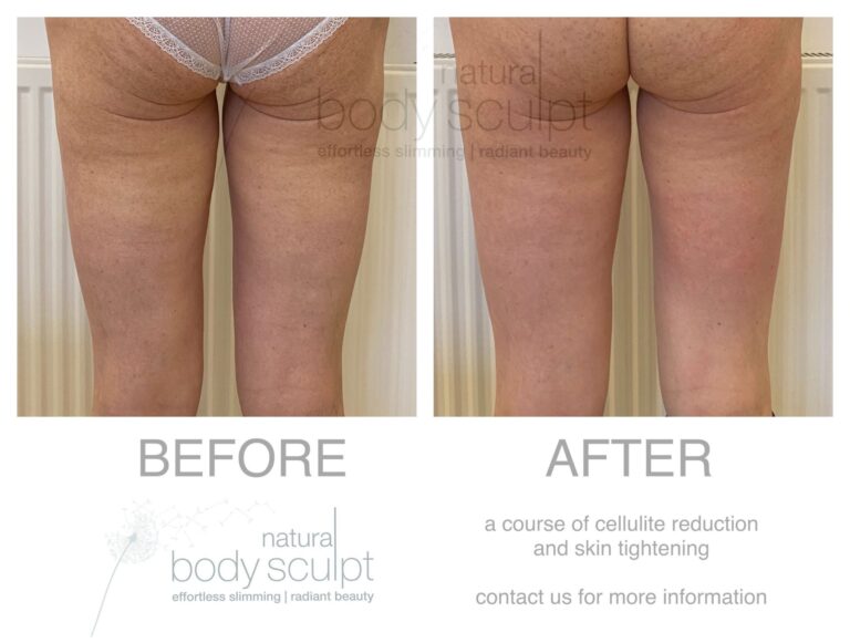 cavitation inch loss and cellulite reduction (1)