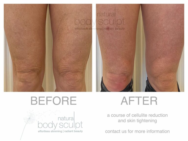 cavitation inch loss and cellulite reduction (3)