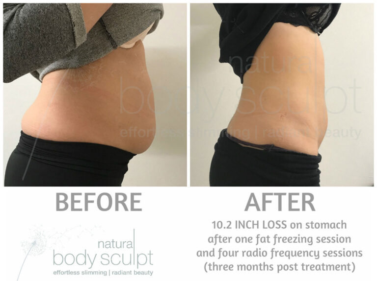 fat-freezing-1