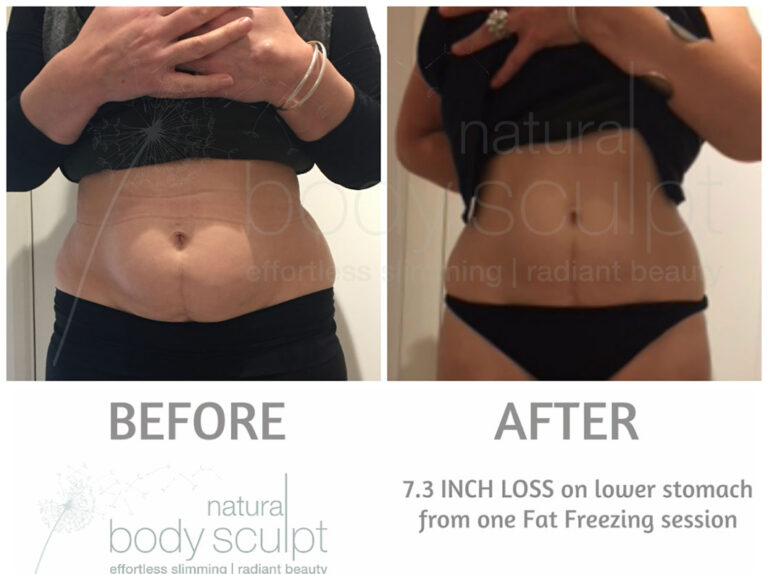 fat-freezing-10