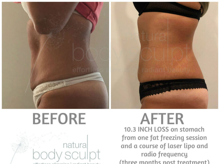 fat-freezing-11