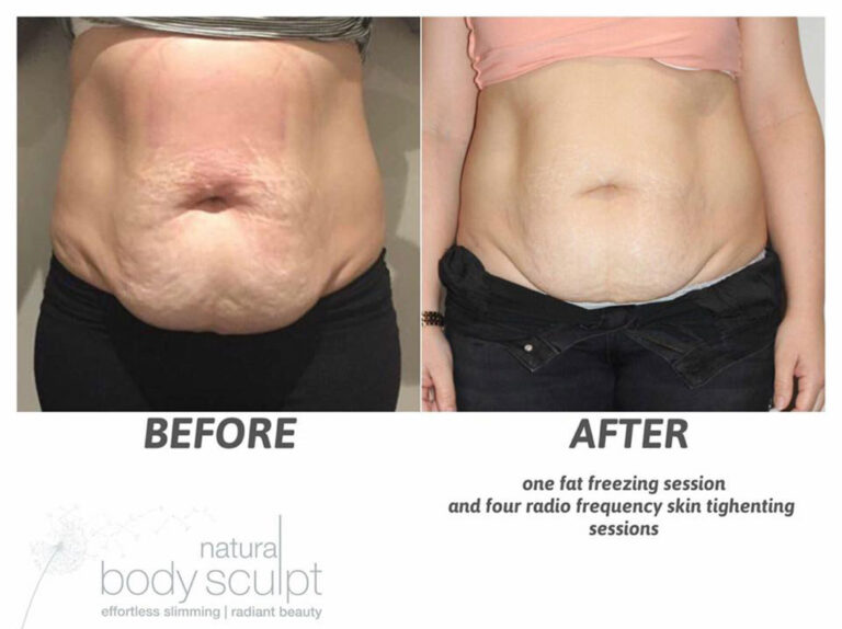 fat-freezing-13