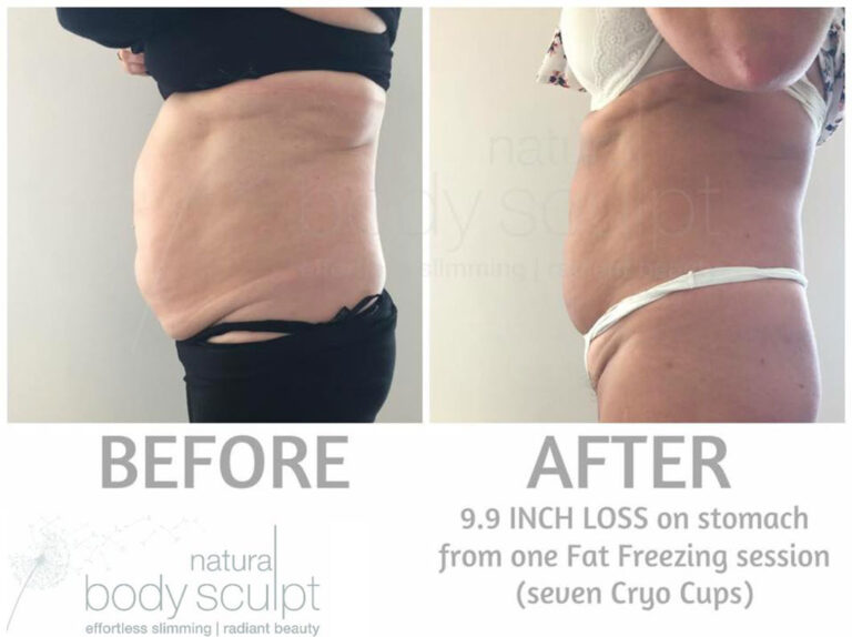 fat-freezing-14