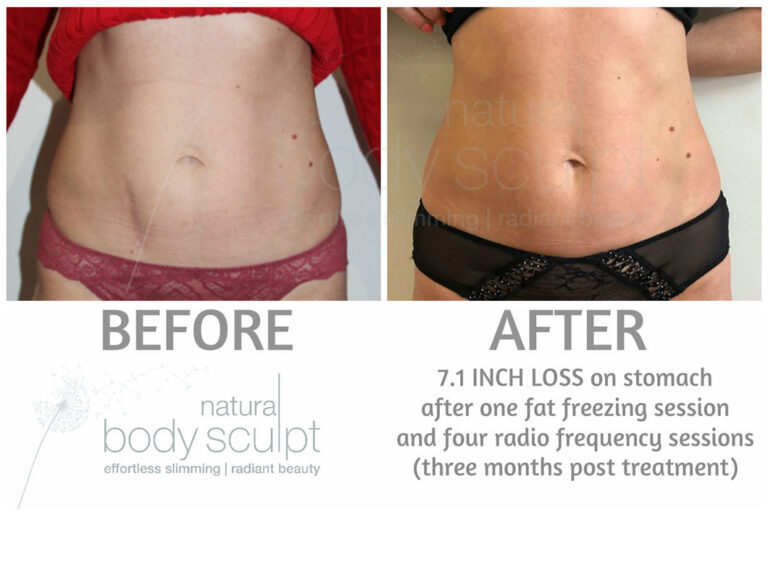 fat-freezing-2