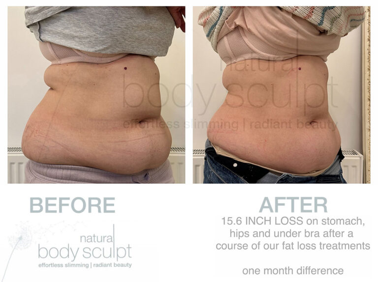 fat-freezing-37