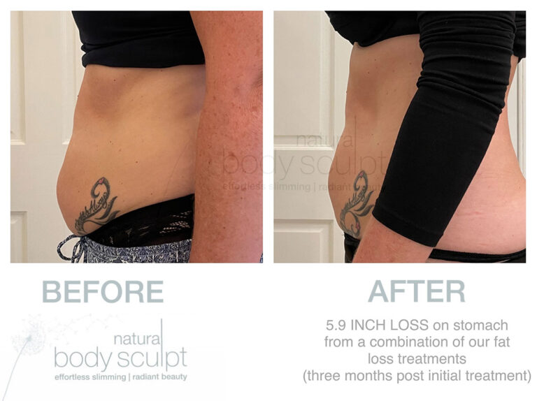 fat-freezing-39
