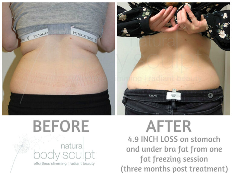 fat-freezing-4