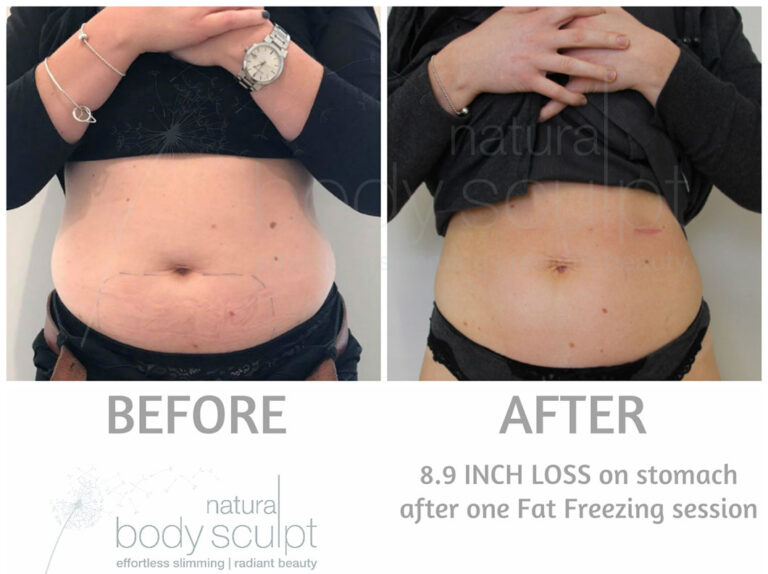 fat-freezing-5