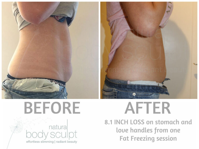 fat-freezing-6