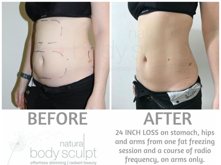 fat-freezing-7