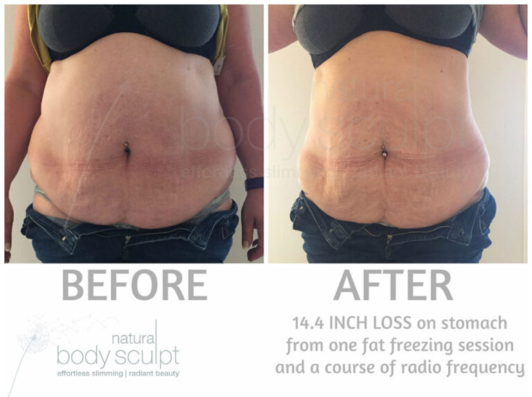 fat-freezing-8