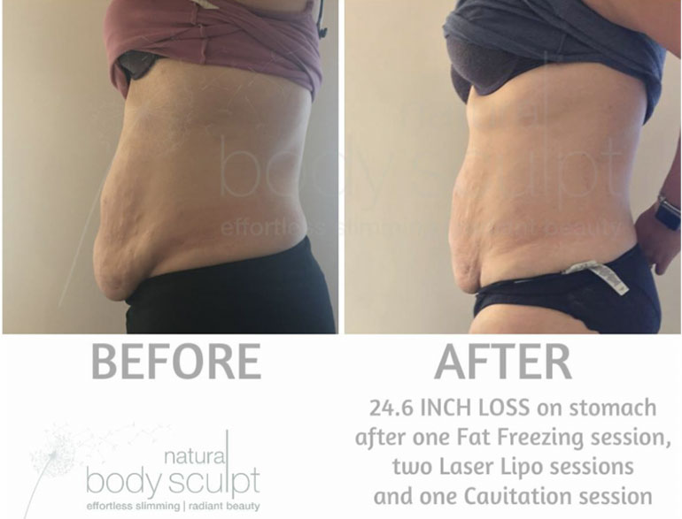Bodysculpt - Fat Freezing before and after