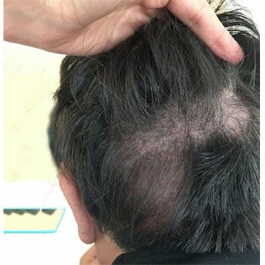 Hair Loss