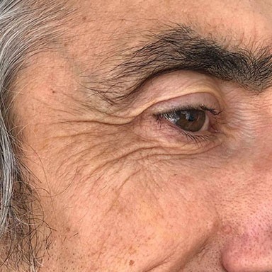 natural bodysculpt - hifu facelift and body treatments