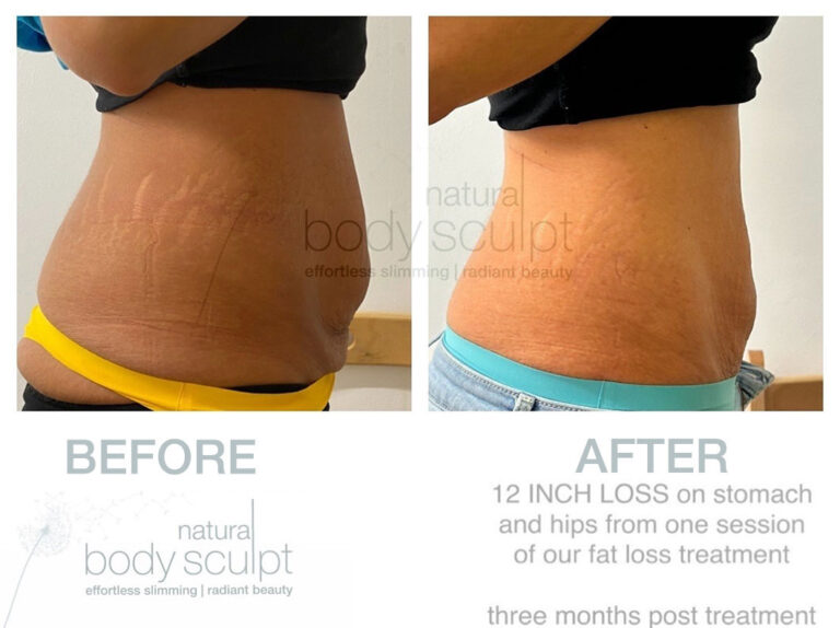 laser-lipo-results-11