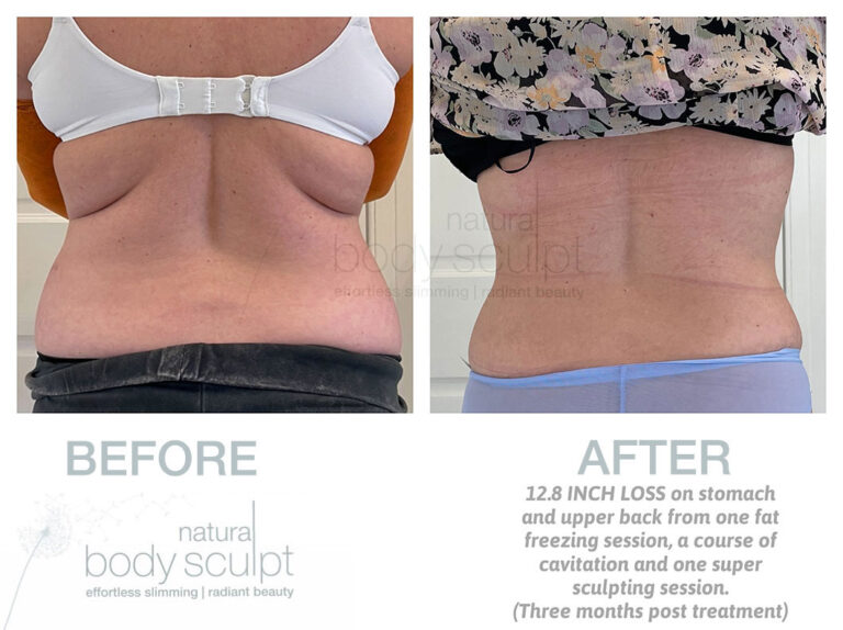 laser-lipo-results-12
