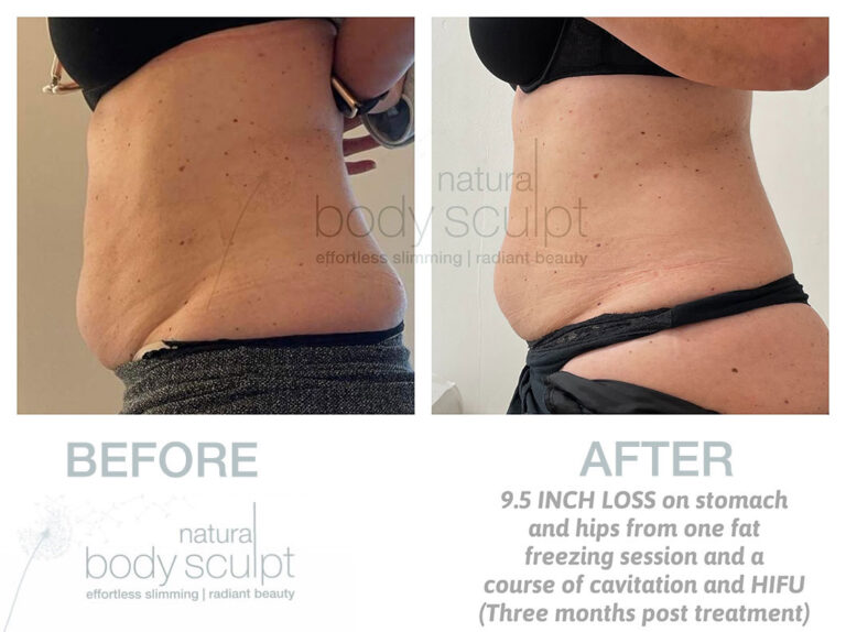 laser-lipo-results-13