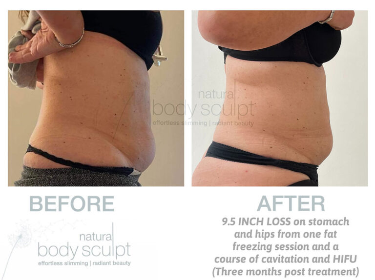 laser-lipo-results-14