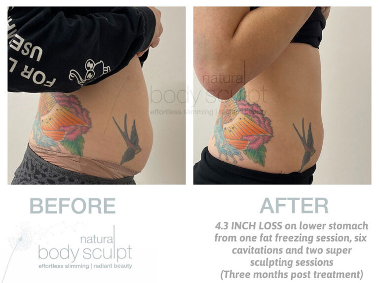 laser-lipo-results-17