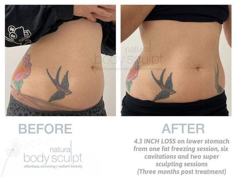 laser-lipo-results-18