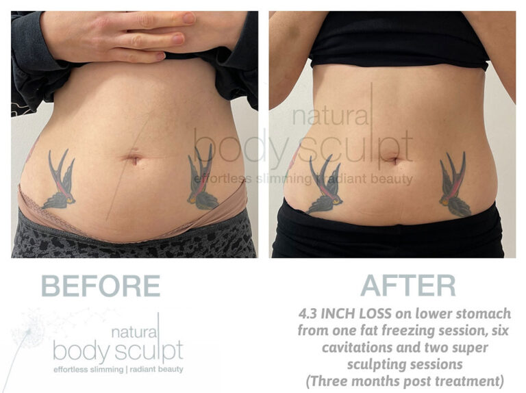 laser-lipo-results-19