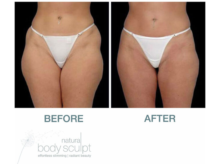 laser-lipo-results-2
