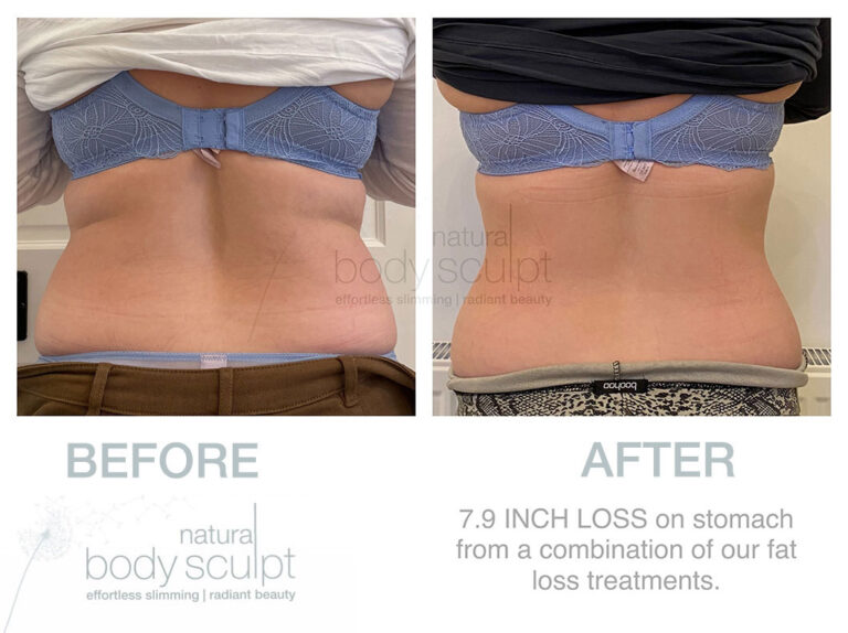 laser-lipo-results-20