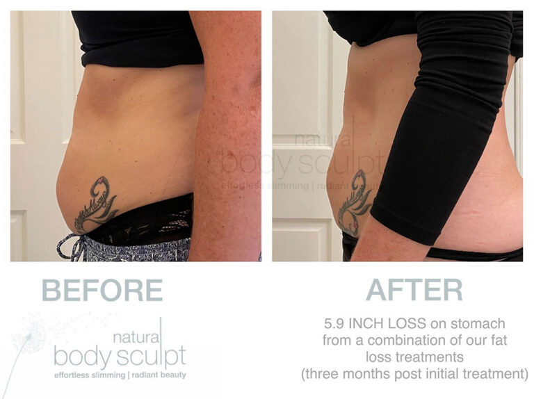 laser-lipo-results-21