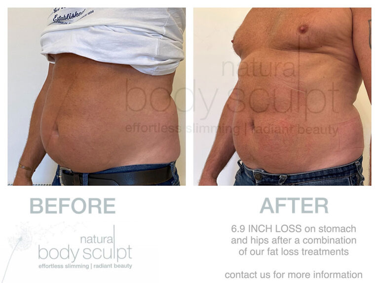 laser-lipo-results-4