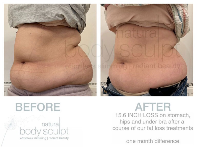 laser-lipo-results-8