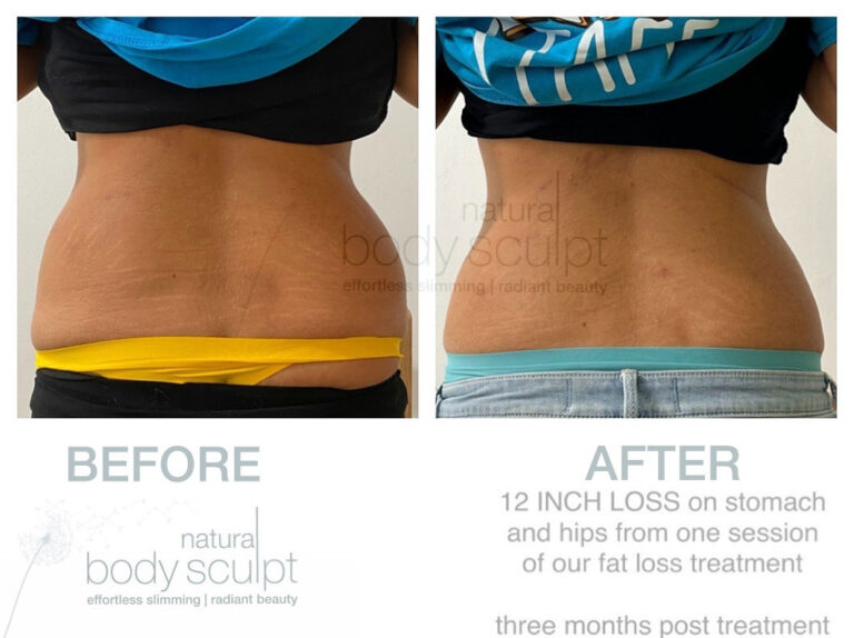 laser-lipo-results-9