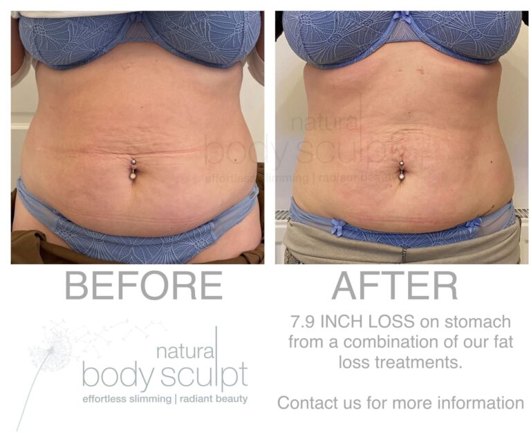 laser_lipo_01