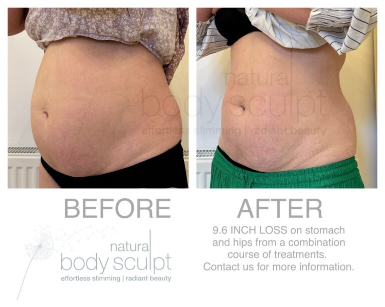 laser_lipo