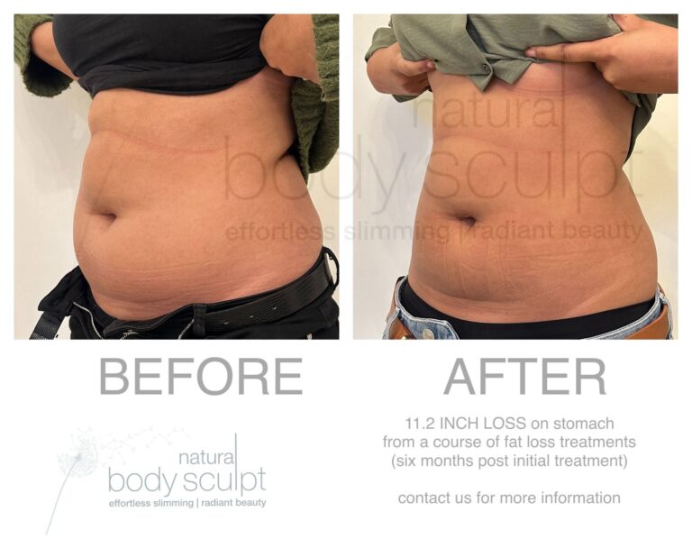 laser lipo