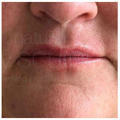 Lip plumping