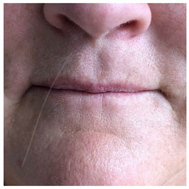 Lip plumping