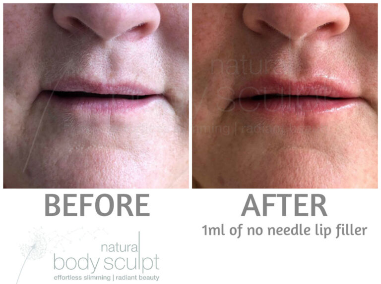 No Needle Filler