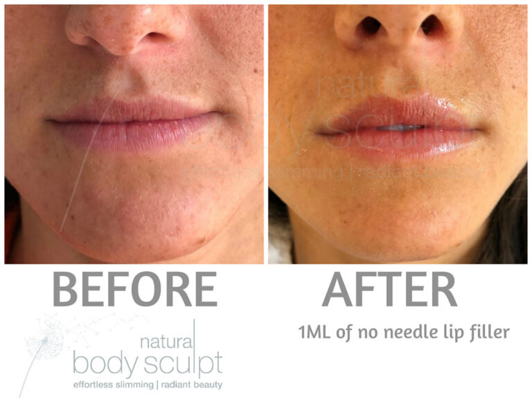 No Needle Filler