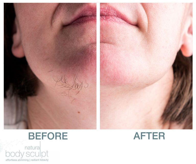 permanent hair removal-chin-before-after